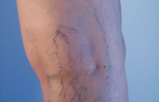 křečové žíly na nohou u žen