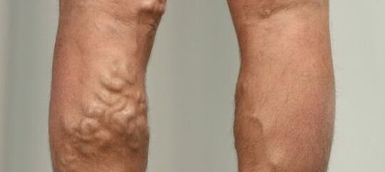 křečové žíly na nohou