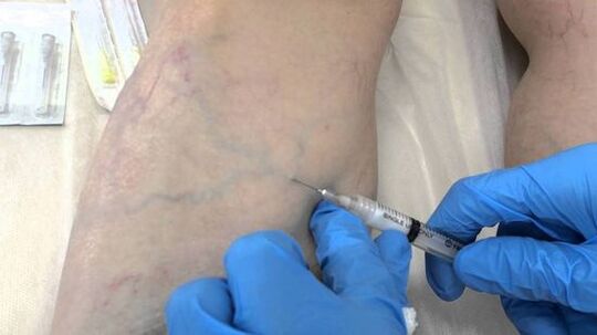 skleroterapie pro křečové žíly na nohou u žen